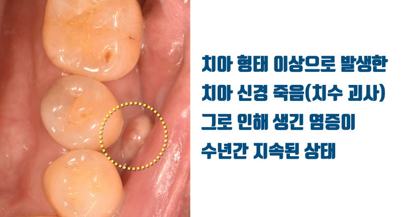 [연예인 환자 치료 후기] 오랫동안 방치된 치아 염증의 1주일만에 해결 #치아살리기 #플라젠 #최용훈원장 사진 2