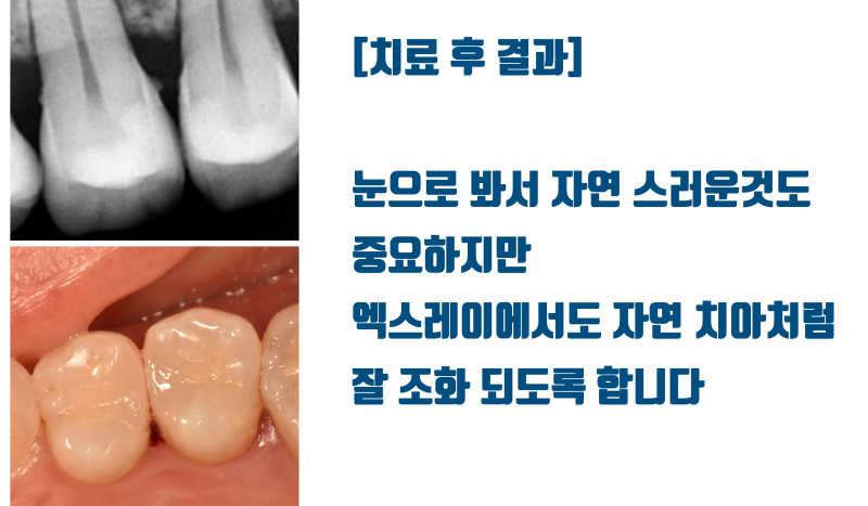 [엑스레이까지 자연스럽게] 설명들 듣고 봐야 이해되는 신경 치료 없이 자연스러운 부분 세라믹 치료 #세라믹치료 #치아살리기 #최용훈원장 사진 4