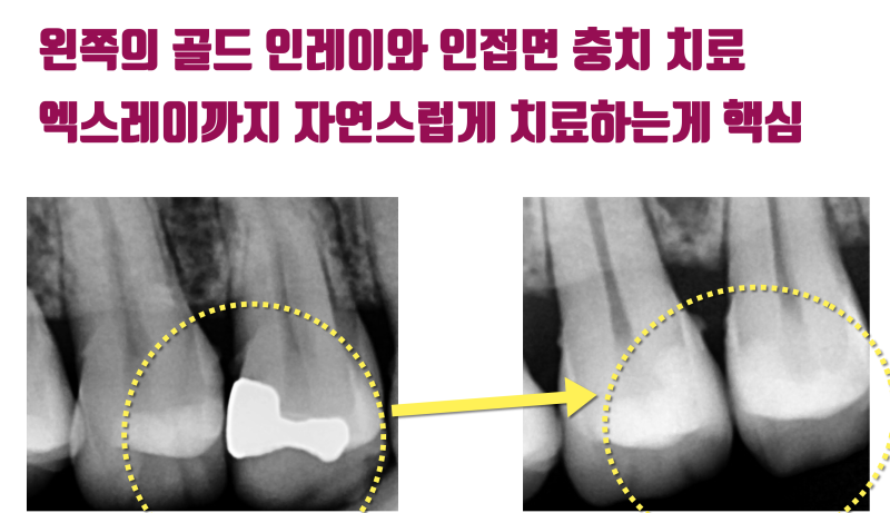 [엑스레이까지 자연스럽게] 설명들 듣고 봐야 이해되는 신경 치료 없이 자연스러운 부분 세라믹 치료 #세라믹치료 #치아살리기 #최용훈원장