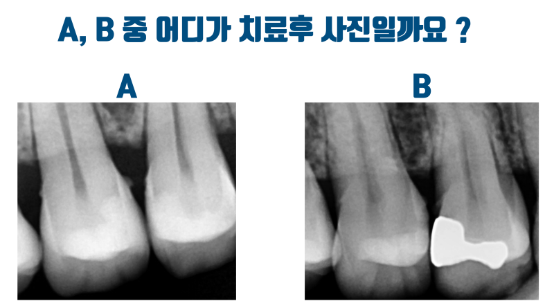 [엑스레이까지 자연스럽게] 설명들 듣고 봐야 이해되는 신경 치료 없이 자연스러운 부분 세라믹 치료 #세라믹치료 #치아살리기 #최용훈원장 사진 2