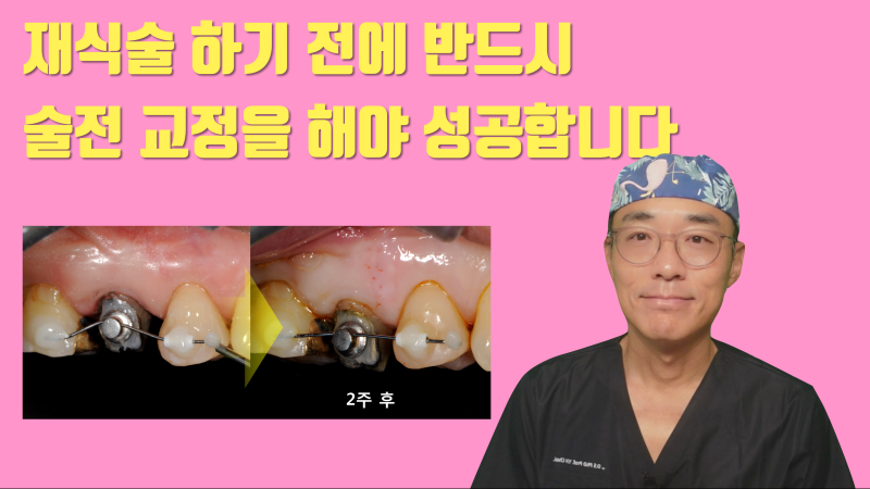 [재식술 성공의 키포인트] 반드시 술전 교정 치료를 해야 재식술에 성공합니다 #재식술 #치아재식술 #최용훈원장