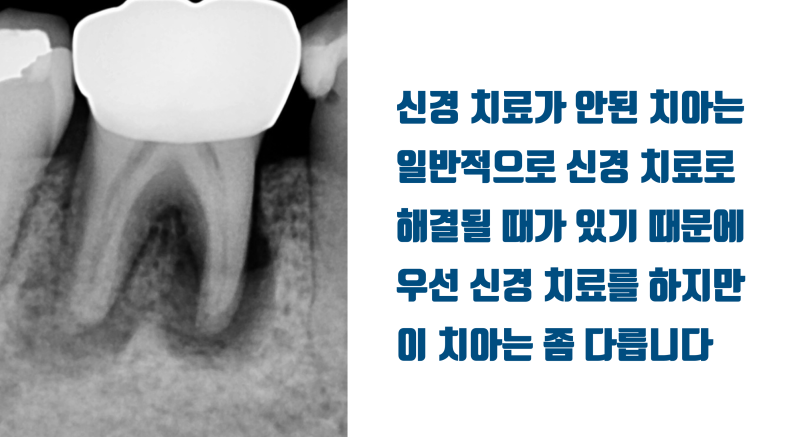[일반인들이 모르는 치아의 심각성] 크라운까지 된 치아에 저절로 발생된 크렉의 해결 #재식술 #치아재식술 #최용훈원장