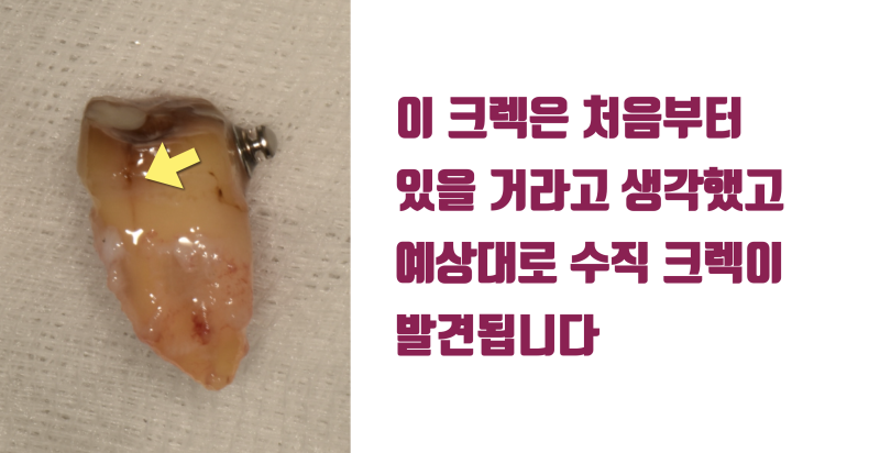 [일반인들이 모르는 치아의 심각성] 크라운까지 된 치아에 저절로 발생된 크렉의 해결 #재식술 #치아재식술 #최용훈원장 사진 3