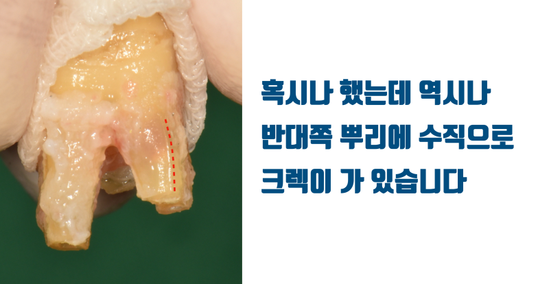 [일반인들이 모르는 치아의 심각성] 크라운까지 된 치아에 저절로 발생된 크렉의 해결 #재식술 #치아재식술 #최용훈원장 사진 4