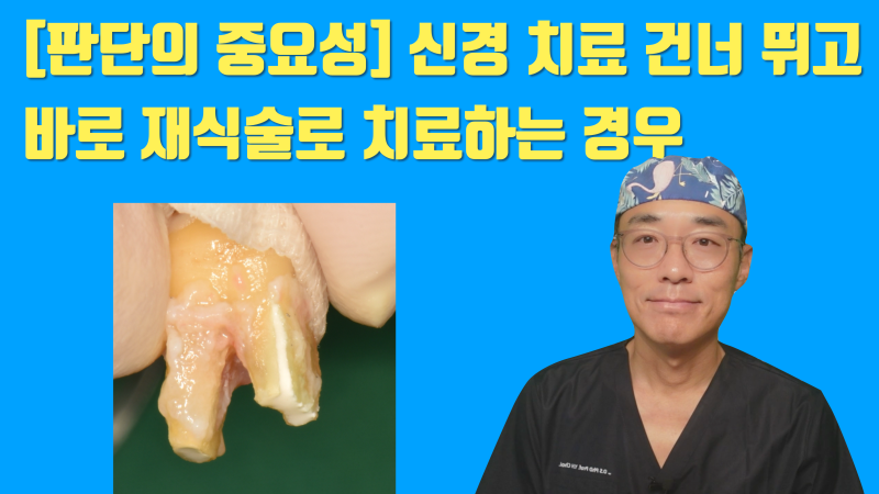 [일반인들이 모르는 치아의 심각성] 크라운까지 된 치아에 저절로 발생된 크렉의 해결 #재식술 #치아재식술 #최용훈원장