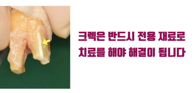 [일반인들이 모르는 치아의 심각성] 크라운까지 된 치아에 저절로 발생된 크렉의 해결 #재식술 #치아재식술 #최용훈원장 사진 5