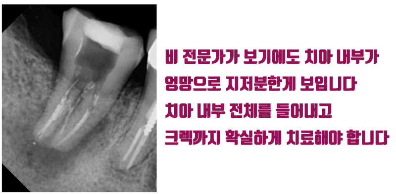 [의사의 치아살리기] 의사(Doctor)들이 더 자연 치아를 살리고 싶어 하는 이유에 대해서 #재식술 #치아재식술 #최용훈원장 사진 3