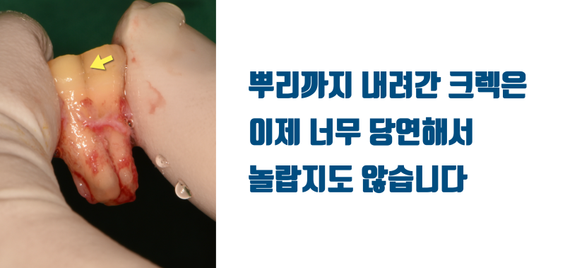 [의사의 치아살리기] 의사(Doctor)들이 더 자연 치아를 살리고 싶어 하는 이유에 대해서 #재식술 #치아재식술 #최용훈원장 사진 2
