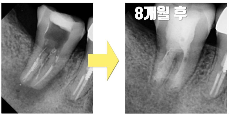 [의사의 치아살리기] 의사(Doctor)들이 더 자연 치아를 살리고 싶어 하는 이유에 대해서 #재식술 #치아재식술 #최용훈원장