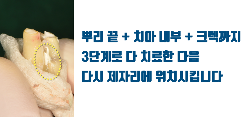 [저주 받은 치아] 태생적으로 살리기가 어려운 뿌리가 긴 치아를 살린 경우 #재식술 #크렉재식술 #최용훈원장 사진 6