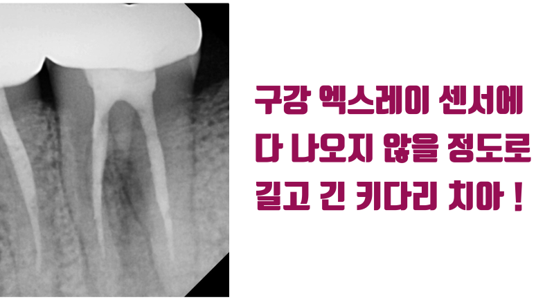 [저주 받은 치아] 태생적으로 살리기가 어려운 뿌리가 긴 치아를 살린 경우 #재식술 #크렉재식술 #최용훈원장 사진 3