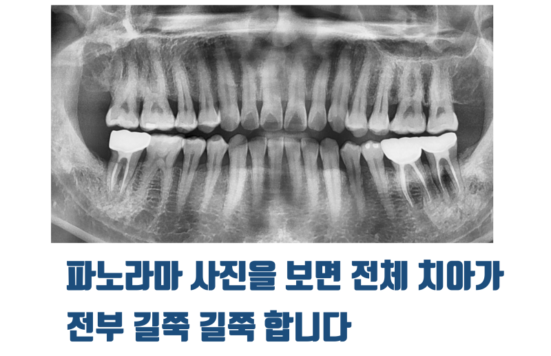 [저주 받은 치아] 태생적으로 살리기가 어려운 뿌리가 긴 치아를 살린 경우 #재식술 #크렉재식술 #최용훈원장 사진 2