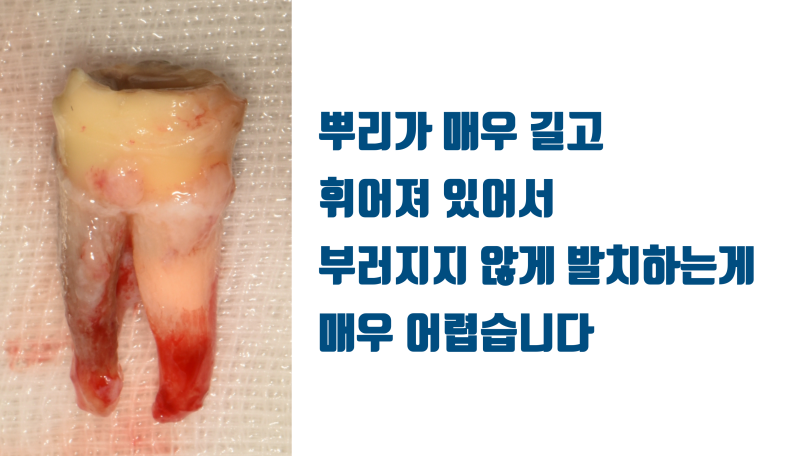 [저주 받은 치아] 태생적으로 살리기가 어려운 뿌리가 긴 치아를 살린 경우 #재식술 #크렉재식술 #최용훈원장