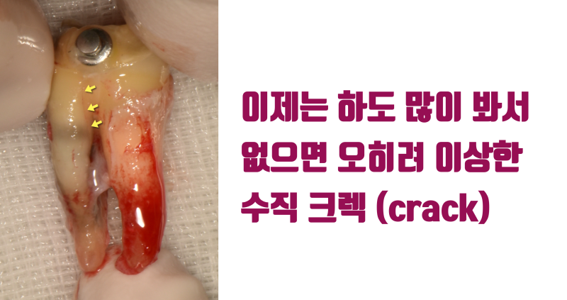 [저주 받은 치아] 태생적으로 살리기가 어려운 뿌리가 긴 치아를 살린 경우 #재식술 #크렉재식술 #최용훈원장 사진 5