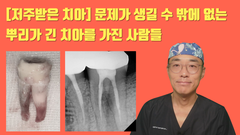 [저주 받은 치아] 태생적으로 살리기가 어려운 뿌리가 긴 치아를 살린 경우 #재식술 #크렉재식술 #최용훈원장