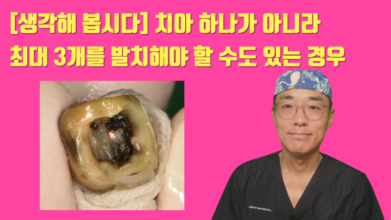 [한번 생각해 봅시다] 단순히 치아냐 임플란트가 아니라 치아를 뽑았을 때 주변에 미칠 영향도 생각해야 합니다 #재식술 #치아살리기 #최용훈원장