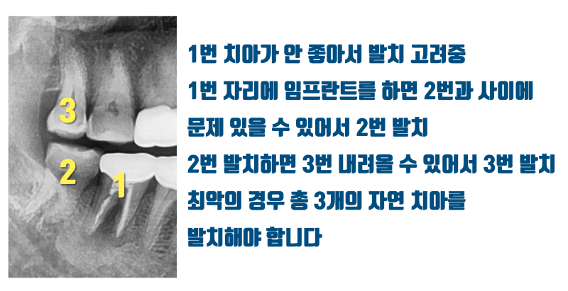 [한번 생각해 봅시다] 단순히 치아냐 임플란트가 아니라 치아를 뽑았을 때 주변에 미칠 영향도 생각해야 합니다 #재식술 #치아살리기 #최용훈원장 사진 2