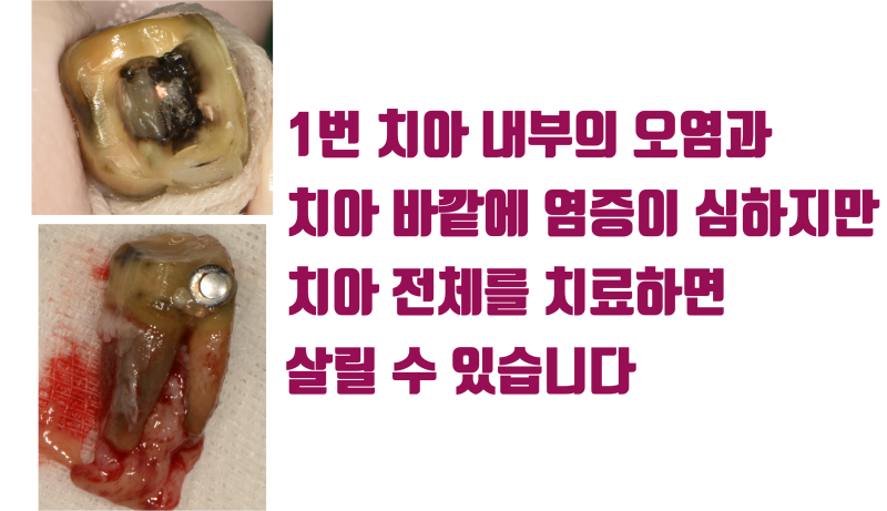 [한번 생각해 봅시다] 단순히 치아냐 임플란트가 아니라 치아를 뽑았을 때 주변에 미칠 영향도 생각해야 합니다 #재식술 #치아살리기 #최용훈원장