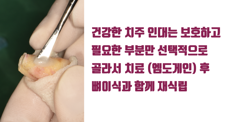 [절망에서 희망으로] 흔들리고 자꾸 붓는 치아를 살리는 원리의 이해 #재식술 #치아살리기 #최용훈원장 사진 3