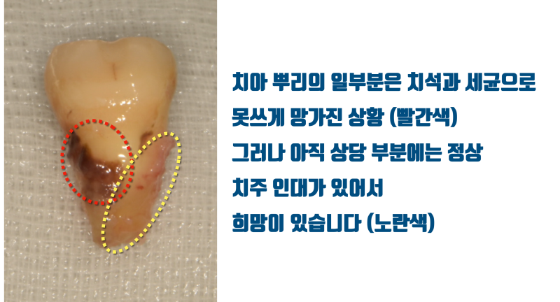 [절망에서 희망으로] 흔들리고 자꾸 붓는 치아를 살리는 원리의 이해 #재식술 #치아살리기 #최용훈원장