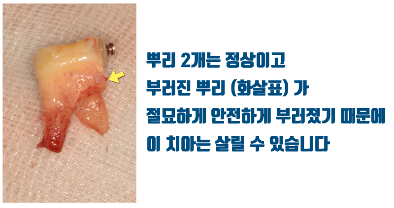 [누구의 책임일까 ?] 크렉과 파절은 환자 본인 스스로 발생시킵니다 #재식술 #치아살리기 #최용훈원장 사진 4