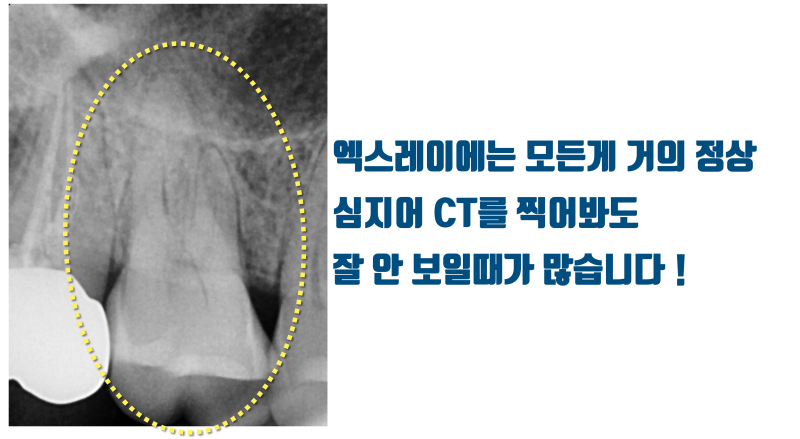 [누구의 책임일까 ?] 크렉과 파절은 환자 본인 스스로 발생시킵니다 #재식술 #치아살리기 #최용훈원장