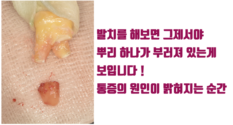 [누구의 책임일까 ?] 크렉과 파절은 환자 본인 스스로 발생시킵니다 #재식술 #치아살리기 #최용훈원장 사진 3