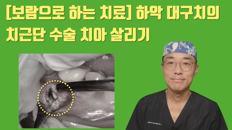 [어렵지만 보람있는 치근단수술] 옆 치아까지 번진 염증 치아의 치근단 수술 해결 #치근단수술 #치근절제술 #최용훈원장