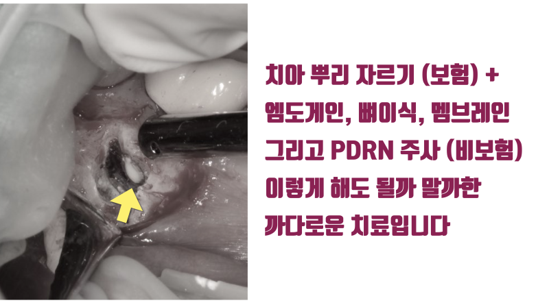 [어렵지만 보람있는 치근단수술] 옆 치아까지 번진 염증 치아의 치근단 수술 해결 #치근단수술 #치근절제술 #최용훈원장 사진 3