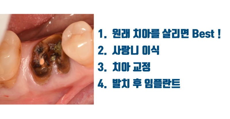 [일반인이 잘 모르는 치아 이식] 사랑니 이식이 가능한지 확인해보고 임플란트 결정이 낫습니다 #사랑니이식 #치아이식 #최용훈원장
