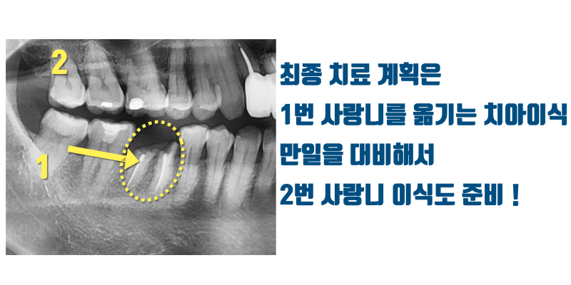 [일반인이 잘 모르는 치아 이식] 사랑니 이식이 가능한지 확인해보고 임플란트 결정이 낫습니다 #사랑니이식 #치아이식 #최용훈원장 사진 4