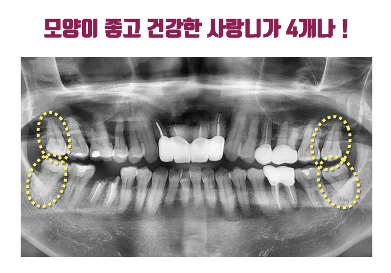 [일반인이 잘 모르는 치아 이식] 사랑니 이식이 가능한지 확인해보고 임플란트 결정이 낫습니다 #사랑니이식 #치아이식 #최용훈원장 사진 3