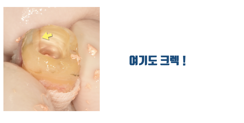 [이런 치아도 살렸다] 뿌리가 벌어진 발치가 어려움 + 크렉 치아의 재식술 치료 #재식술 #치아재식술 #최용훈원장 사진 5