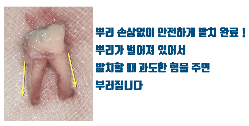 [이런 치아도 살렸다] 뿌리가 벌어진 발치가 어려움 + 크렉 치아의 재식술 치료 #재식술 #치아재식술 #최용훈원장 사진 3