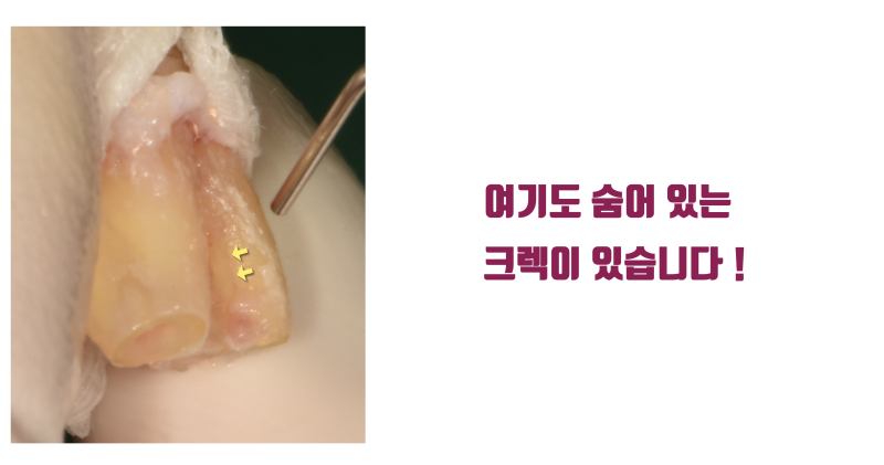 [이런 치아도 살렸다] 뿌리가 벌어진 발치가 어려움 + 크렉 치아의 재식술 치료 #재식술 #치아재식술 #최용훈원장 사진 6