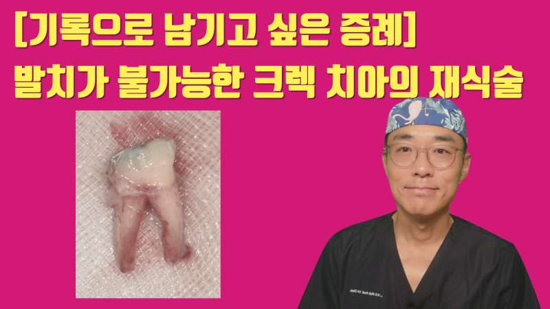 [이런 치아도 살렸다] 뿌리가 벌어진 발치가 어려움 + 크렉 치아의 재식술 치료 #재식술 #치아재식술 #최용훈원장