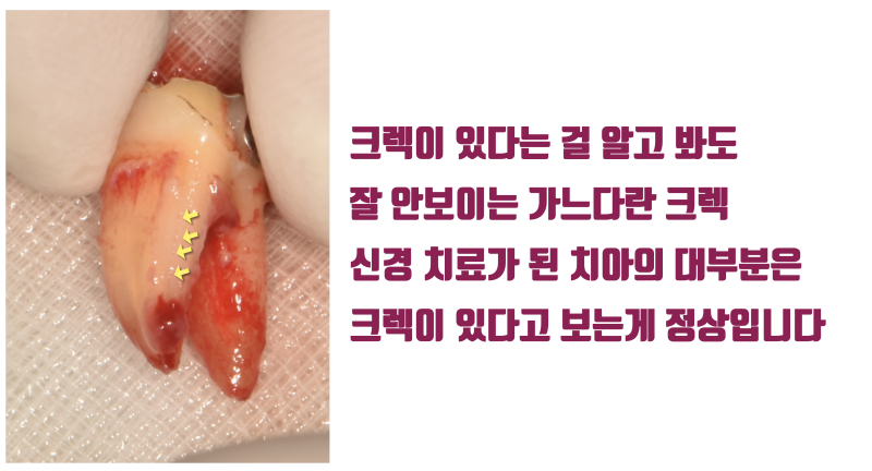[이런 치아도 살렸다] 뿌리가 벌어진 발치가 어려움 + 크렉 치아의 재식술 치료 #재식술 #치아재식술 #최용훈원장 사진 4