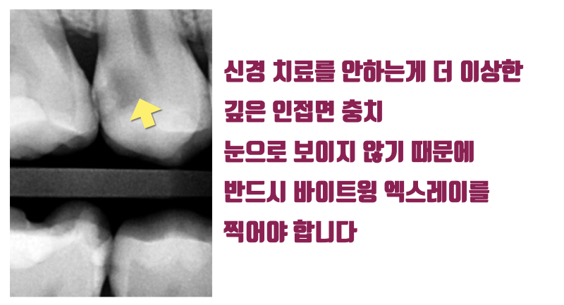 [신경 치료 안하게] 전기 화학적 치료 + 신경 보호 전용 재료로 깊은 충치를 신경 치료 안하도록 하는 방법 #최소삭제 #치아살리기 #최용훈원장 사진 2