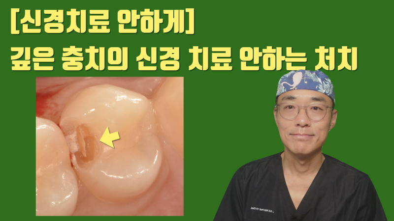 [신경 치료 안하게] 전기 화학적 치료 + 신경 보호 전용 재료로 깊은 충치를 신경 치료 안하도록 하는 방법 #최소삭제 #치아살리기 #최용훈원장