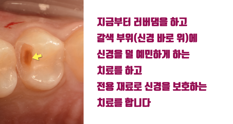 [신경 치료 안하게] 전기 화학적 치료 + 신경 보호 전용 재료로 깊은 충치를 신경 치료 안하도록 하는 방법 #최소삭제 #치아살리기 #최용훈원장 사진 5