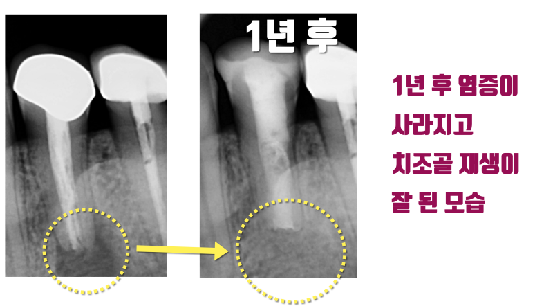 신경까지 진행된 염증의 재식술 치아 살리기 #재식술 #치아살리기 #최용훈원장 사진 3
