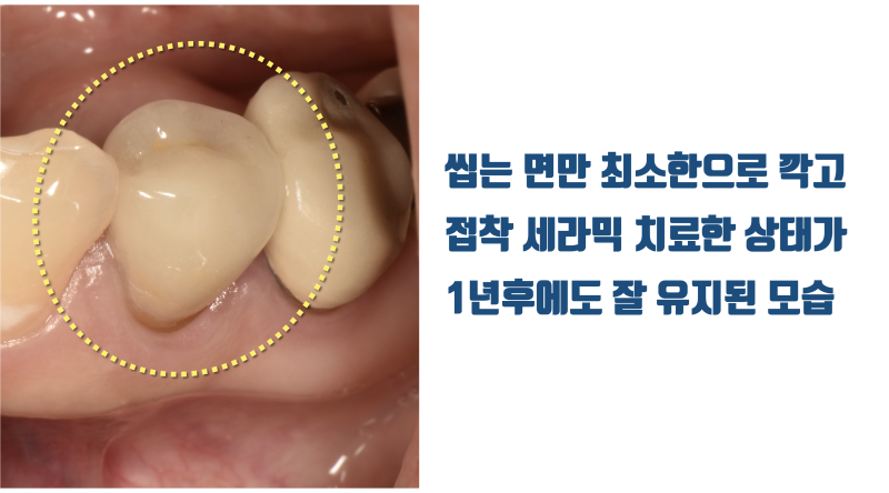 신경까지 진행된 염증의 재식술 치아 살리기 #재식술 #치아살리기 #최용훈원장