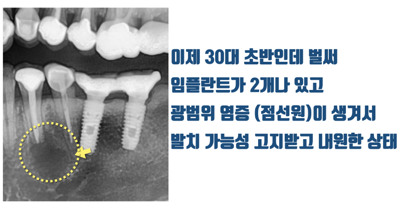 신경까지 진행된 염증의 재식술 치아 살리기 #재식술 #치아살리기 #최용훈원장 사진 2