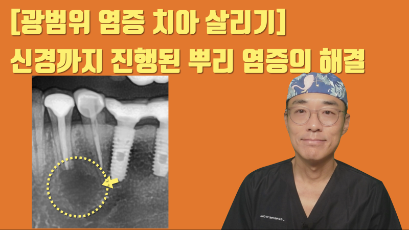 신경까지 진행된 염증의 재식술 치아 살리기 #재식술 #치아살리기 #최용훈원장