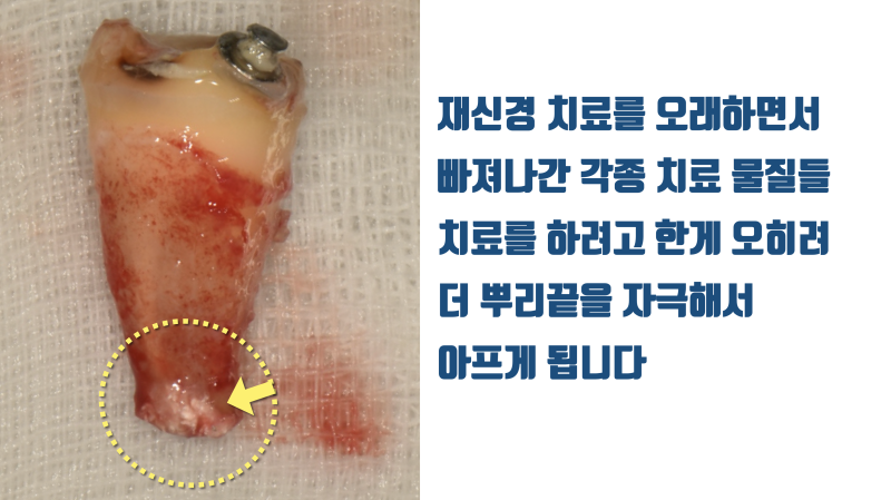 환자도 의사도 잘 모르는 재신경 치료의 실체에 대해 솔직하게 알아봅시다 #치아살리기 #최용훈원장