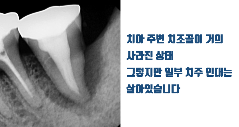 [역사적인 치아 살리기] 치조골이 완전히 무너진 치석 + 세균 덩어리 치아의 재생 치료 #재식술 #치아살리기 #최용훈원장 사진 2