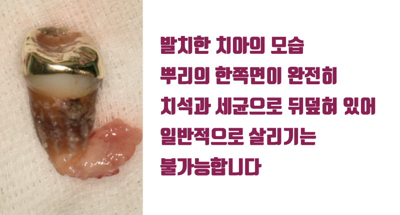 [역사적인 치아 살리기] 치조골이 완전히 무너진 치석 + 세균 덩어리 치아의 재생 치료 #재식술 #치아살리기 #최용훈원장 사진 3