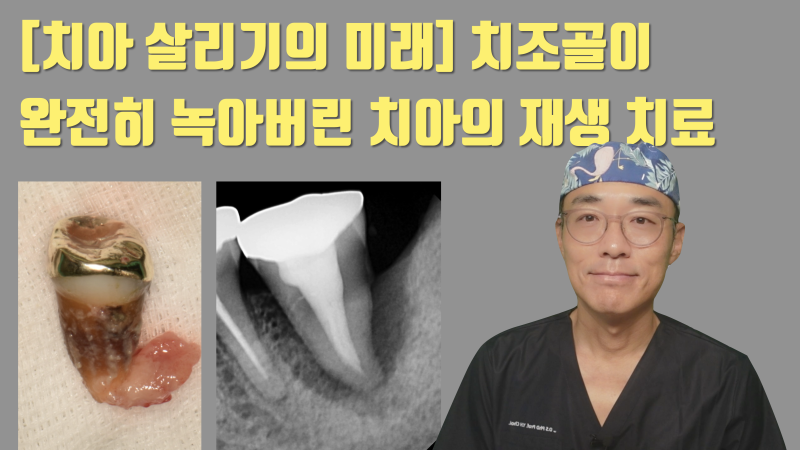 [역사적인 치아 살리기] 치조골이 완전히 무너진 치석 + 세균 덩어리 치아의 재생 치료 #재식술 #치아살리기 #최용훈원장
