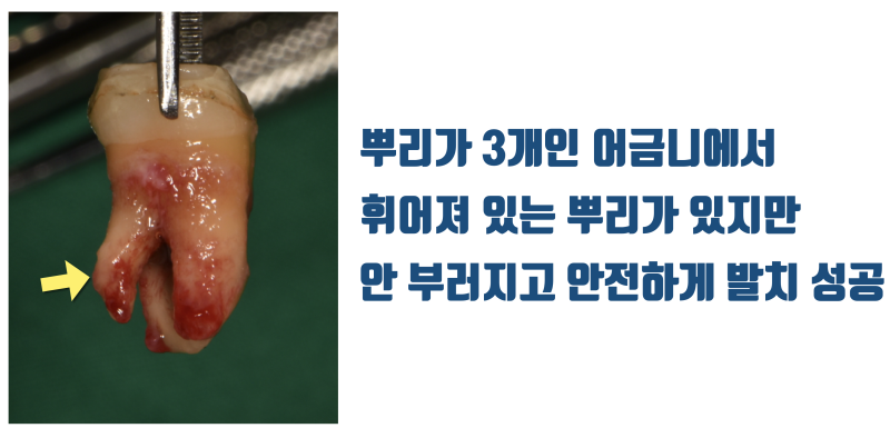 [보람있는 치료] 휘어진 뿌리 + 기둥까지 박힌 치아의 성공적인 치료 #재식술 #치아재식술 #최용훈원장 사진 3