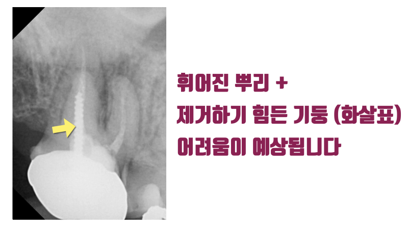 [보람있는 치료] 휘어진 뿌리 + 기둥까지 박힌 치아의 성공적인 치료 #재식술 #치아재식술 #최용훈원장